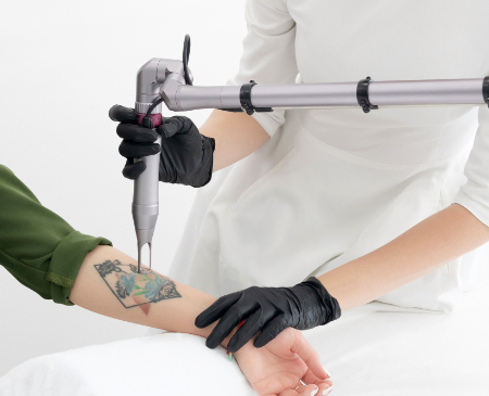 tattoo removal