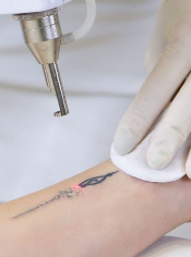 tattoo removal
