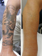tattoo removal